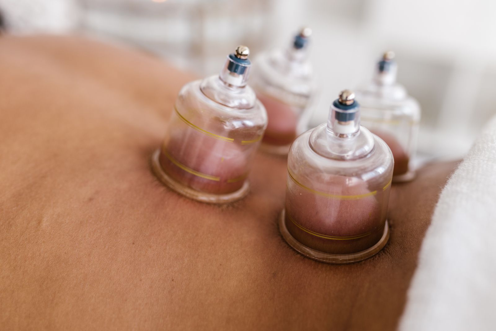 Cupping therapy glass cups applied to a patient's upper back for muscle and pain relief